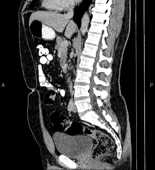 Acute appendicitis (Radiopaedia 84780-100240 Sagittal C+ portal venous phase 51).jpg
