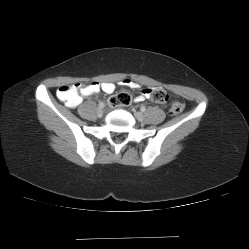 File:Acute appendicitis (Radiopaedia 9417-10099 Axial C+ portal venous phase 1).jpg