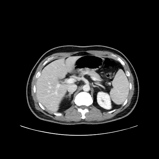 Acute appendicitis and COVID 19 pneumonia (Radiopaedia 76604-88380 Axial C+ portal venous phase 23).jpg