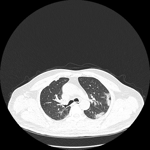 Acute appendicitis and COVID 19 pneumonia (Radiopaedia 76604-88380 Axial lung window 20).jpg