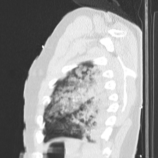 Acute aspiration pneumonitis (Radiopaedia 33605-34703 Sagittal lung window 75).jpg