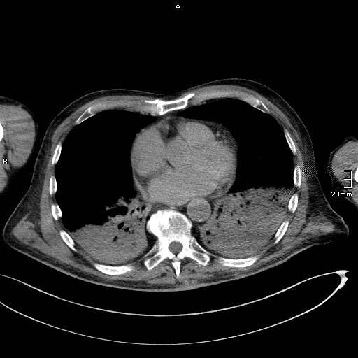 Acute aspiration pneumonitis (Radiopaedia 55642-62166 Axial liver window 40).jpg