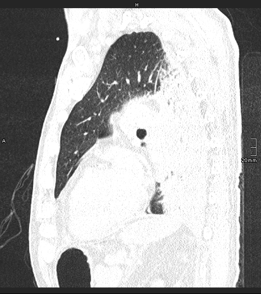 Acute aspiration pneumonitis (Radiopaedia 55642-62166 Sagittal lung window 50).jpg