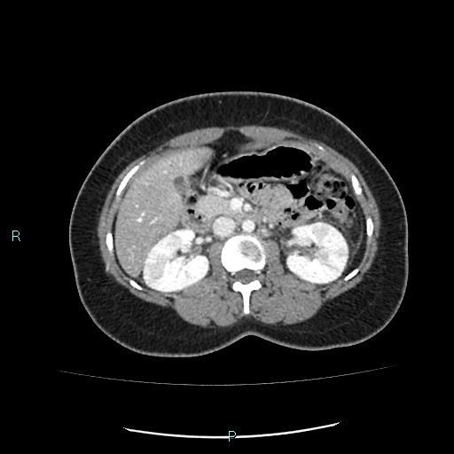 Acute bilateral pyelonephritis (Radiopaedia 37146-38881 Axial C+ portal venous phase 43).jpg