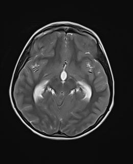 File:Acute cerebellar ataxia (Radiopaedia 61487-69446 Axial T2 10).jpg