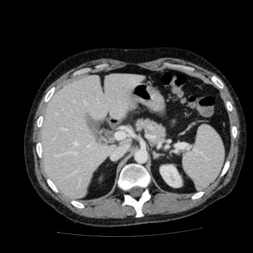 Acute cholecystitis and incidental left sided IVC (Radiopaedia 49352-54459 Axial C+ portal venous phase 48).jpg