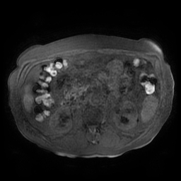 File:Acute cholecystitis complicated by pylephlebitis (Radiopaedia 65782-74915 Axial T1 fat sat 77).jpg