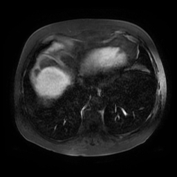 File:Acute cholecystitis complicated by pylephlebitis (Radiopaedia 65782-74915 Axial arterioportal phase T1 C+ fat sat 2).jpg