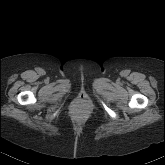 Acute colonic hemorrhage in ulcerative colitis (Radiopaedia 77415-89538 Axial non-contrast 150).jpg
