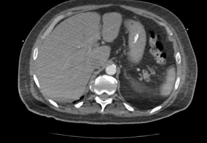 Acute cor pulmonale (ultrasound) (Radiopaedia 83508-98818 Axial C+ CTPA 84).jpg