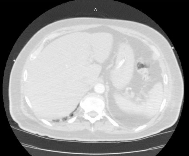 Acute cor pulmonale (ultrasound) (Radiopaedia 83508-98818 Axial lung window 88).jpg
