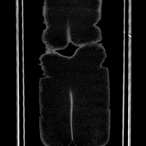 Acute diverticulitis - transverse colon (Radiopaedia 87063-103327 Coronal C+ portal venous phase 162).jpg