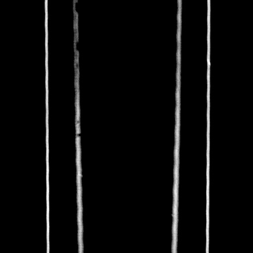 Acute diverticulitis - transverse colon (Radiopaedia 87063-103327 Coronal C+ portal venous phase 173).jpg