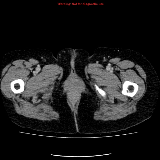 Acute gangrenous cholecystitis (Radiopaedia 10123-10661 Axial C+ portal venous phase 112).jpg