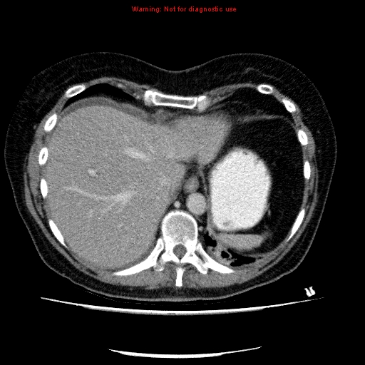 Acute gangrenous cholecystitis (Radiopaedia 10123-10661 Axial C+ portal venous phase 15).jpg