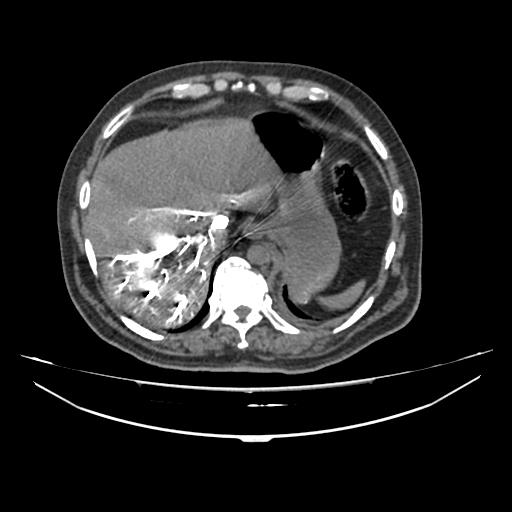 File:Acute heart failure (CT) (Radiopaedia 79835-93075 Axial C+ arterial phase 68).jpg
