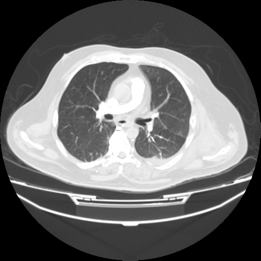 File:Acute heart failure (CT) (Radiopaedia 79835-93075 Axial lung window 22).png