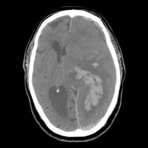 Acute hemorrhagic stroke (Radiopaedia 17507-17223 Axial non-contrast 26).jpg