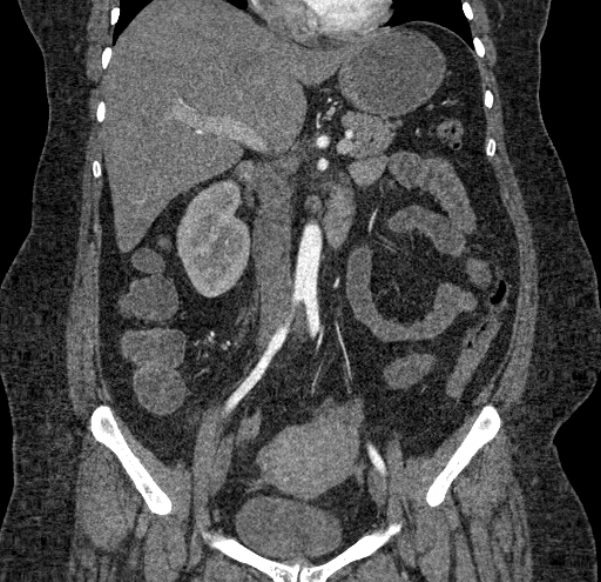 Acute mesenteric ischemia (Radiopaedia 80029-93316 Coronal C+ arterial phase 69).jpg