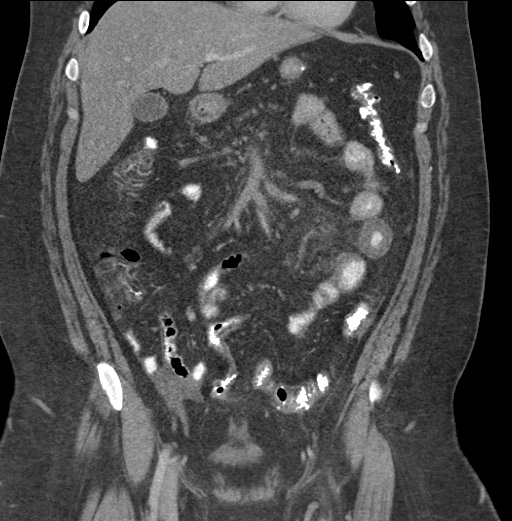 Acute mesenteric venous ischemia (Radiopaedia 46041-50383 Coronal C+ portal venous phase 37).jpg