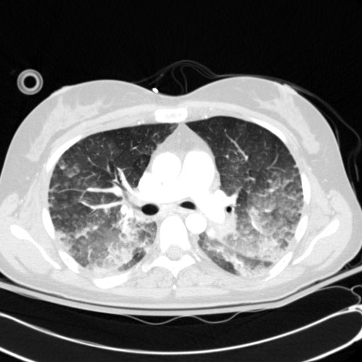 Acute myocardial infarction in CT (Radiopaedia 39947-42415 Axial lung window 52).jpg
