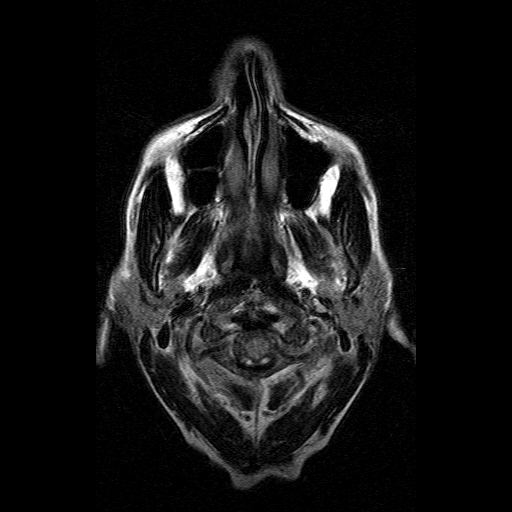 File:Acute necrotizing toxoplasma encephalitis (Radiopaedia 10683-11149 Axial FLAIR 19).jpg