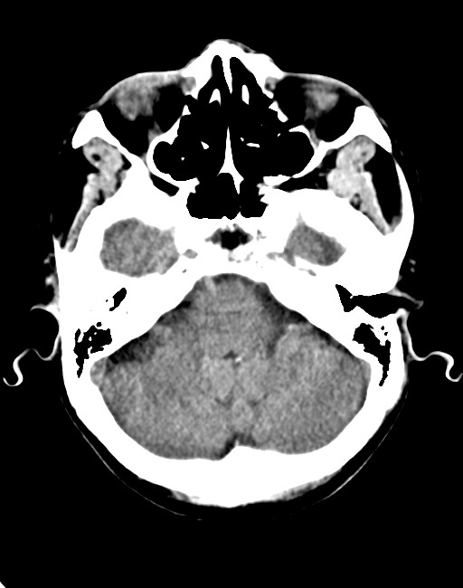 Acute on chronic subdural hematoma (Radiopaedia 74814-85823 Axial non-contrast 32).jpg