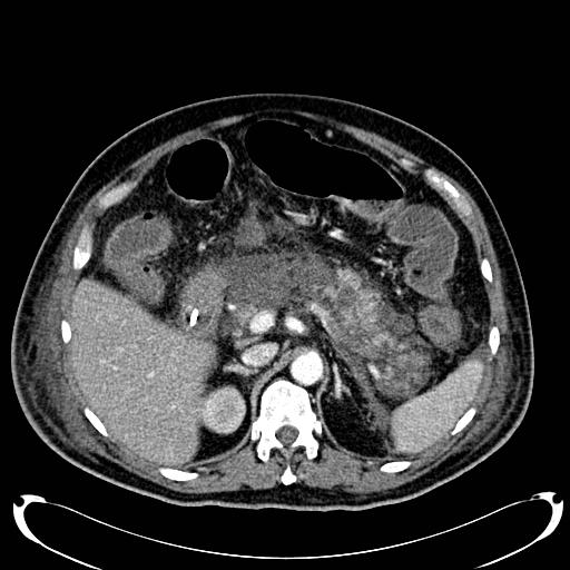 Acute pancreatic necrosis (Radiopaedia 13560-18500 Axial C+ portal venous phase 51).jpg