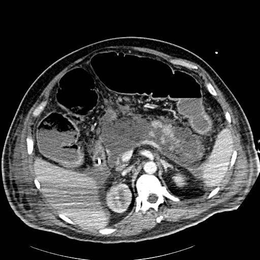 File:Acute pancreatic necrosis (Radiopaedia 13560-18502 Axial C+ portal venous phase 24).jpg