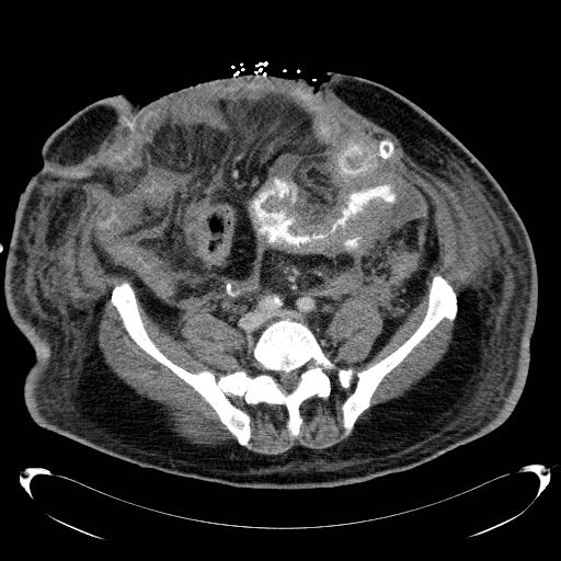 Acute pancreatic necrosis (Radiopaedia 13560-18503 Axial C+ portal venous phase 56).jpg