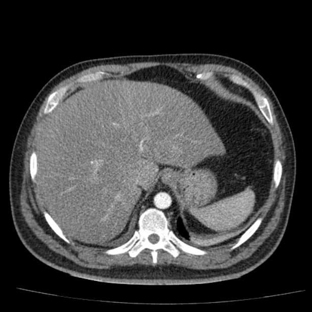 Acute pancreatitis (Radiopaedia 26663-26813 Axial C+ arterial phase 21).jpg