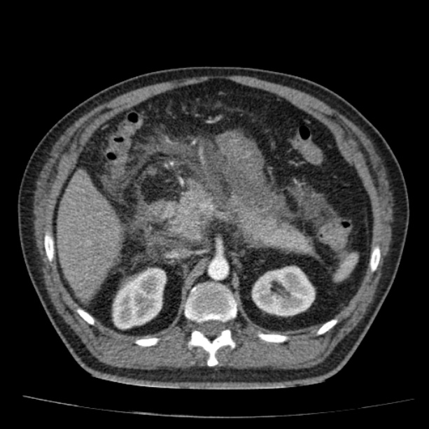 Acute pancreatitis (Radiopaedia 26663-26813 Axial C+ arterial phase 37).jpg