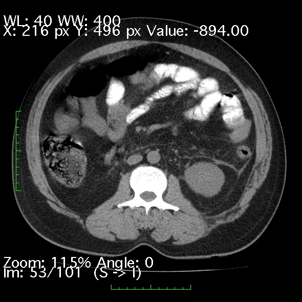 Acute pancreatitis (Radiopaedia 34043-35276 Axial non-contrast 53).jpg