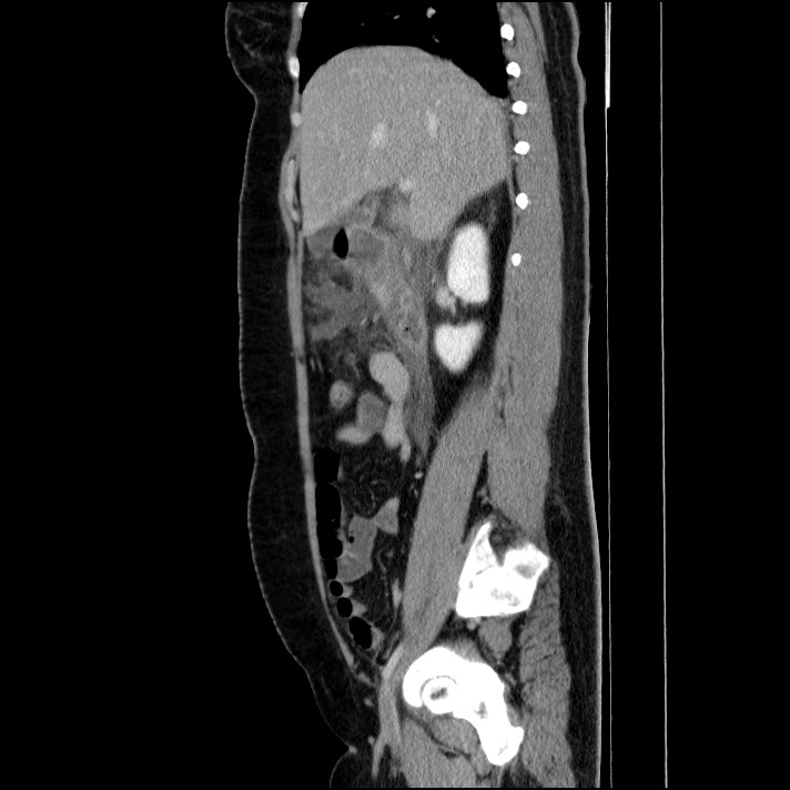 Acute pancreatitis (Radiopaedia 69236-79012 Sagittal C+ portal venous phase 66).jpg