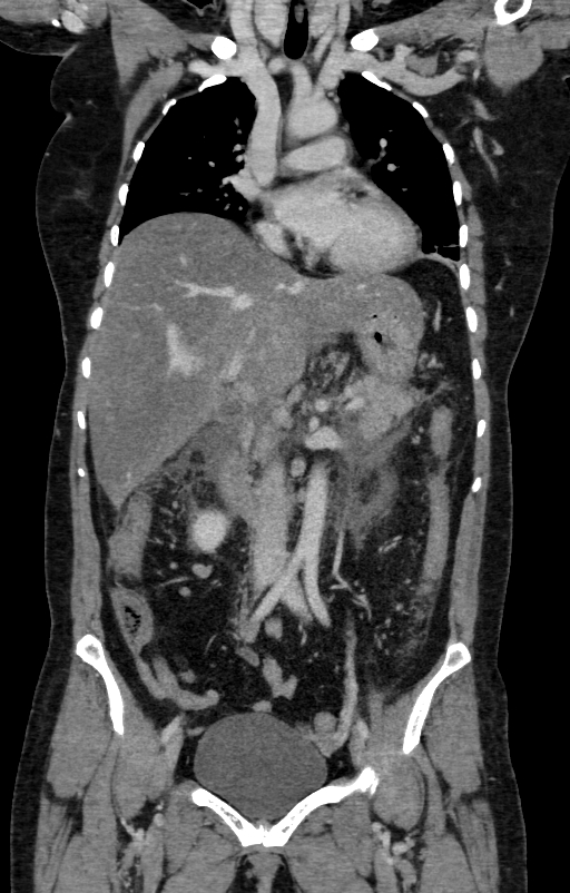 Acute pancreatitis (Radiopaedia 80007-93285 Coronal C+ portal venous phase 49).jpg