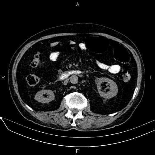 File:Acute pancreatitis (Radiopaedia 85146-100701 Axial non-contrast 58).jpg