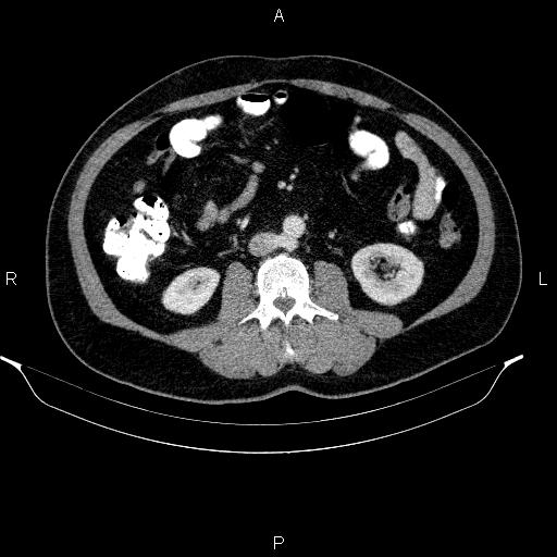 Acute pancreatitis (Radiopaedia 85390-101010 Axial C+ portal venous phase 57).jpg