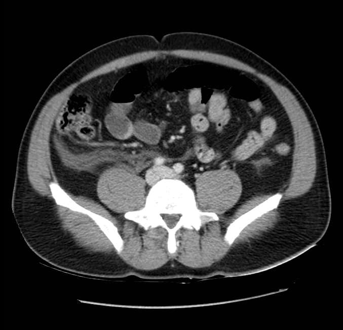 Acute pancreatitis - Balthazar E (Radiopaedia 23080-23110 Axial C+ portal venous phase 46).jpg
