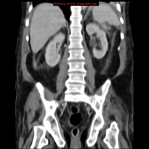 Acute pancreatitis with incidental pancreatic lipoma (Radiopaedia 10190-10730 Coronal C+ portal venous phase 49).jpg