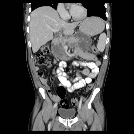 File:Acute pancreatitis with walled off pancreatic necrosis (Radiopaedia 6438-7797 Coronal C+ portal venous phase 2).jpg