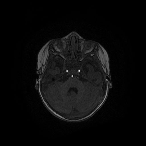 Acute phase of hemiconvulsion-hemiplegia epilepsy syndrome (Radiopaedia 29309-29745 Axial TOF angiography 110).jpg