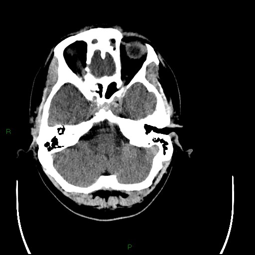 Acute posterior cerebral artery territory infarct (Radiopaedia 79329-92393 Axial non-contrast 23).jpg