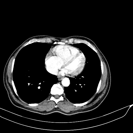 Acute pulmonary embolism (Radiopaedia 69510-79390 D 57).jpg