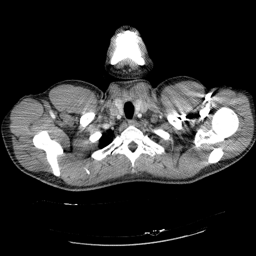 Acute segmental pulmonary emboli and pulmonary infarction (Radiopaedia 62264-70444 Axial C+ CTPA 10).jpg