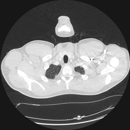 Acute segmental pulmonary emboli and pulmonary infarction (Radiopaedia 62264-70444 Axial lung window 4).jpg