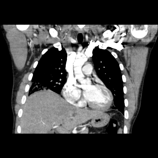 Acute segmental pulmonary emboli and pulmonary infarction (Radiopaedia 62264-70444 Coronal C+ CTPA 19).jpg