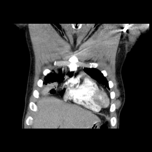 File:Acute segmental pulmonary emboli and pulmonary infarction (Radiopaedia 62264-70444 Coronal C+ CTPA 4).jpg