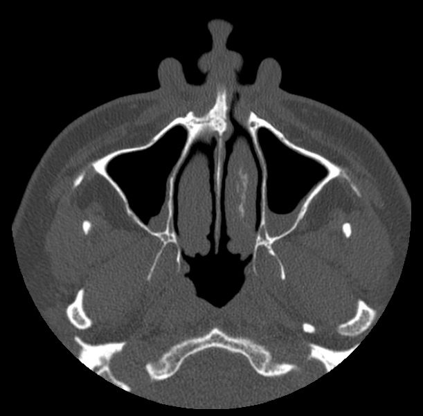 Acute sinusitis (Radiopaedia 23161-23215 Axial bone window 16).jpg