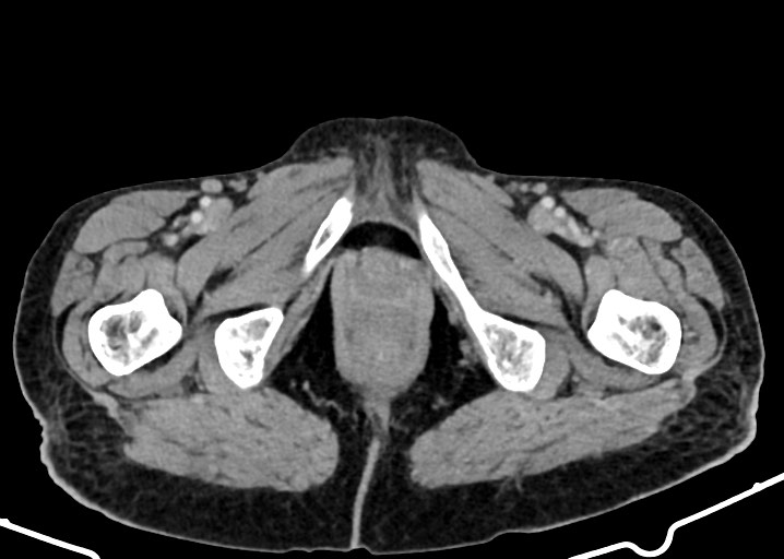 Acute small bowel (ileal) volvulus (Radiopaedia 71740-82139 Axial C+ portal venous phase 209).jpg