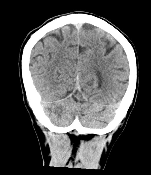 Acute superior cerebellar artery territory infarct (Radiopaedia 84104-99359 Coronal non-contrast 69).jpg